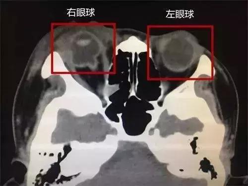 眼外傷眼球破裂傷最新治療方法概述